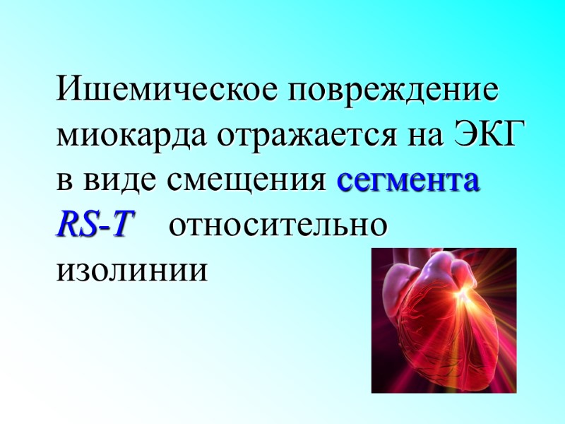 Ишемическое повреждение миокарда отражается на ЭКГ  в виде смещения сегмента RS-T  